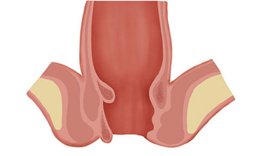 在出汗量较大的季节，还长时间坐着，就容易造成肛门周围的皮肤大量出汗