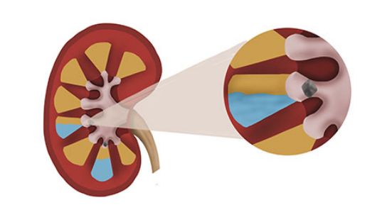 治疗肾结石的方法是多样的，大多数肾结石患者可以通过微创治疗将结石粉碎并排除体外