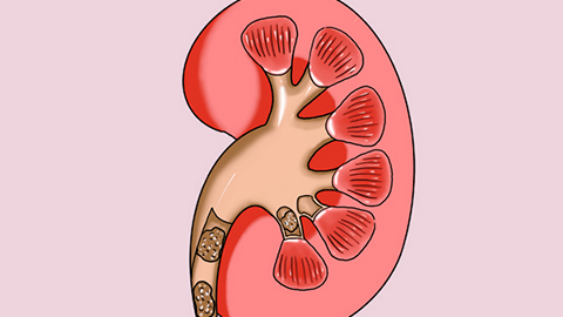 肾结石的人适合吃一些绿豆 肾结石的人适合吃一些绿豆