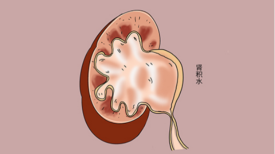 腎積水怎麼治療