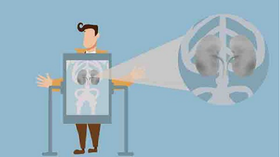 左肾钙化灶主要是指在左肾部位以前可能发生过感染