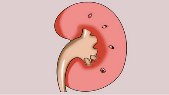 急性肾衰竭经过及时有效的治疗是可以得到缓解的 急性肾衰竭经过及时有效的治疗是可以得到缓解的