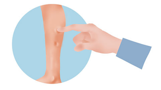 从腿部水肿,慢慢的演变成全身的水肿 从腿部水肿,慢慢的演变成全身的水肿