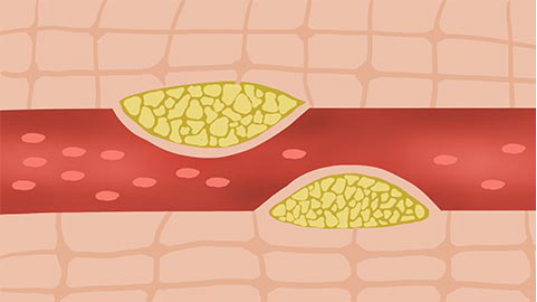如果病情比较严重，血管严重堵塞就要积极的配合医生做各项检查