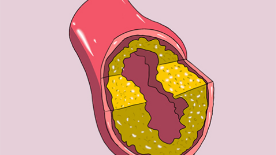 武漢大學人民醫院心血管內科周曉陽醫生_動脈斑塊是什麼意思