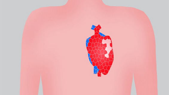 先天性心脏病造成的的右心室曾大，可以考虑早期在专业医师的指导下进行介入治疗或者手术治疗