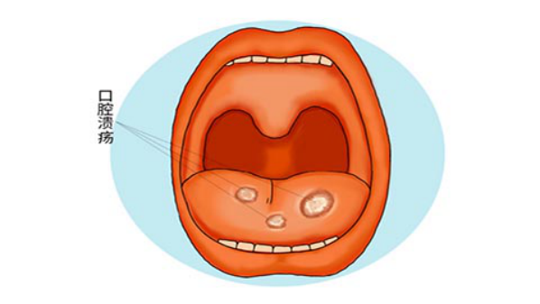 口疮吃什么水果好的快_民福康