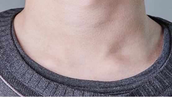 锁骨骨折是一种多发于青少年儿童的疾病