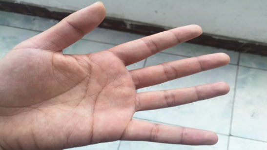 长期的工作劳作会让手掌肌肉、韧带出现慢性劳损