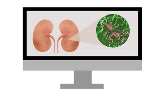 一般来说梗阻性肾病是由于患者的输尿管，又或者时尿道出现了梗阻的现象