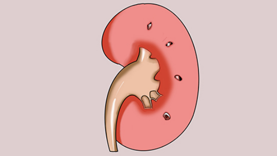肾衰竭早期会让患者出现很疲惫的感觉 肾衰竭早期会让患者出现很疲惫的感觉