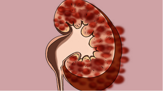 患有肾囊肿的患者往往会感觉到自己的腰腹部有疼痛的感觉 患有肾囊肿的患者往往会感觉到自己的腰腹部有疼痛的感觉