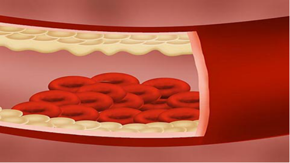 动脉硬化闭塞其实就是血液流通出现问题,正常的血管出现堵塞