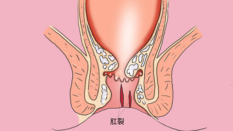 　患者在肛部没有完全恢复之前，要尽量避免少吃辛辣刺激的食物