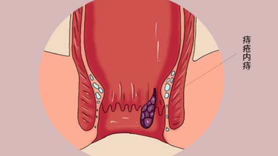 根据病情严重程度不同，患者会出现一些不同的症状，这种痔疮是有痔核的
