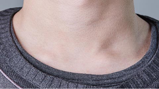 外伤的影响下，锁骨会出现炎症，周围的肌肉出现损伤造成的疼痛