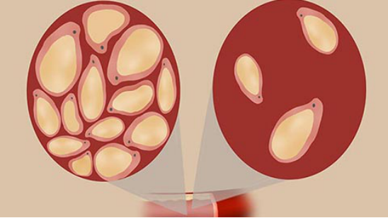 当这个指数偏高的时候，患者身体里面的血液，就会变的比较粘稠