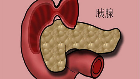 胰瘻能活動是怎麼回事