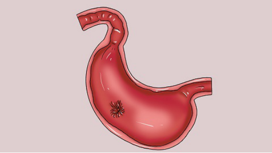 胃炎的发生与患者之前的饮食不合理，长期食用刺激性食物或是饥一顿饱一段