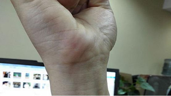 手腕腱鞘炎可以采取中医的方式进行治疗，例如常见的推拿、按摩等