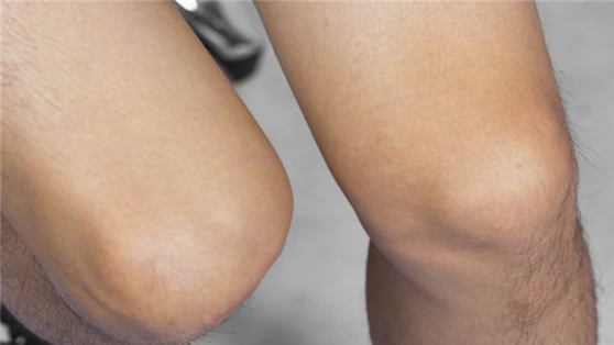 很多患者出现关节积液的原因可能是受到了细菌或者病毒的损害 很多患者出现关节积液的原因可能是受到了细菌或者病毒的损害