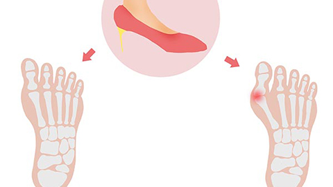 穿着不合较的鞋子,也会形成拇外翻 穿着不合较的鞋子,也会形成拇外翻