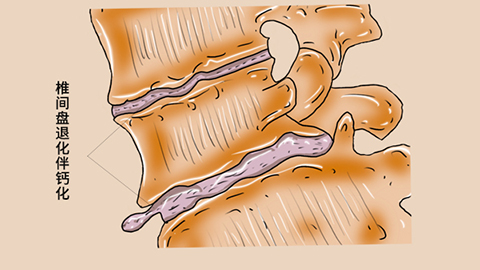 长期从事体力劳动的患者,经常会有完全等东西,可能会导致腰部韧带出现损伤 长期从事体力劳动的患者,经常会有完全等东西,可能会导致腰部韧带出现损伤