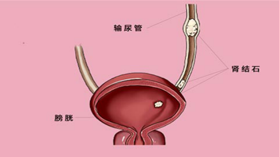 尿结石发作时患者是非常痛苦的