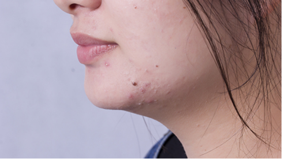 痘印,是由于人们的皮肤遭受了损伤,所出现的恢复痕迹