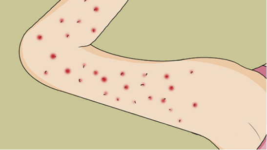身上老是起红疙瘩很痒是怎么回事