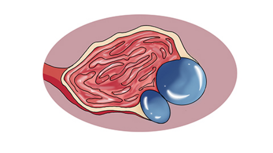 在吃饭的时候，患者吃的菜都需要特别注意，很多比较常见的调味品都是不可以放的