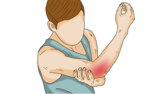 胳膊疼的患者往往是手臂上的肌肉由于各种因素的影响,造成被拉伤的