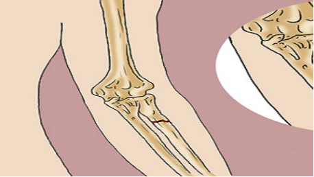 发现自己有脱臼后，不要动保持原有的姿势，等待专业的人员到来进行固定