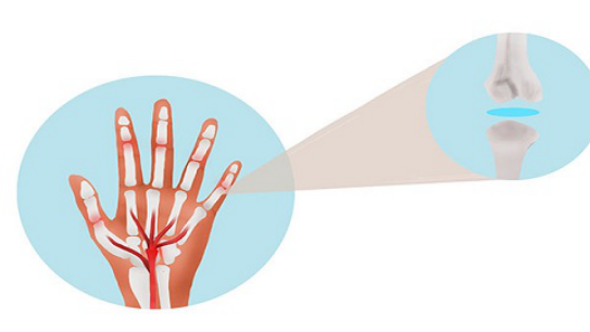 腱鞘炎主要是腱鞘部位受到长时间的摩擦导致发生炎症的现象