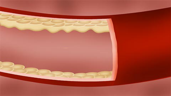 这时患者会出现心口剧烈疼痛的症状，一些患者会感觉自己的胸口出现憋闷