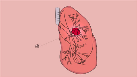 一般不存在痰液或者存在很少的白色泡沫痰,當感染情況愈發嚴重之後