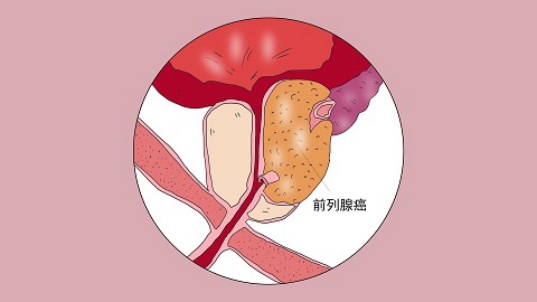 前列腺癌治療最佳方法是什麼