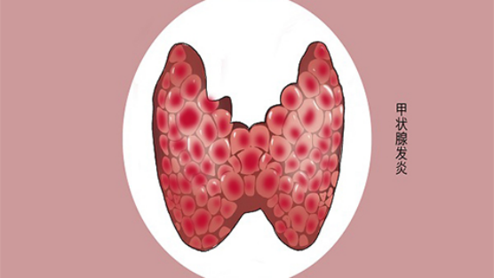 桥本氏甲状腺炎是什么意思