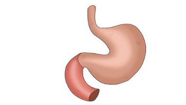 胃息肉就是胃部表面的黏膜组织有一块凸起来的物体