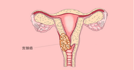 宫颈癌早期前兆图图片