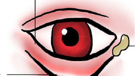 眼睑在面部较为显眼的部位，很多眼睑病都很影响容貌