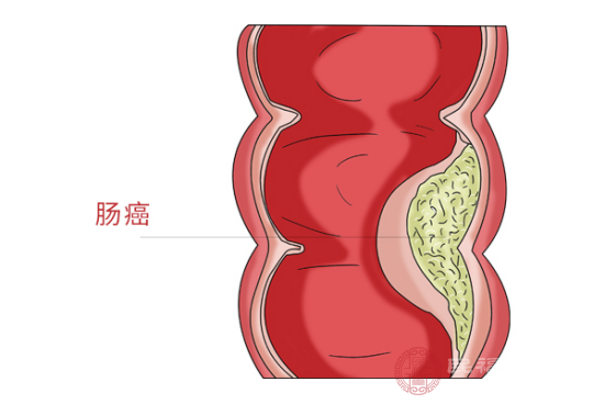 女性肠癌前兆是什么