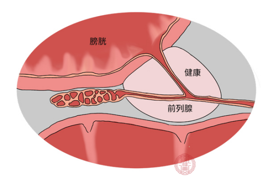 前列腺肥大是什麼原因造成的