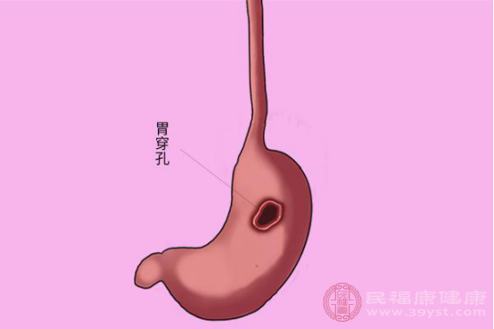 胃穿孔是什么症状