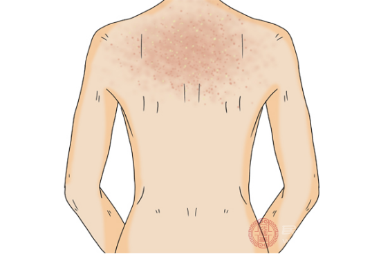夏天身上長紅疙瘩很癢怎麼回事