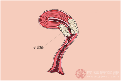 宮頸癌早期症狀有哪些