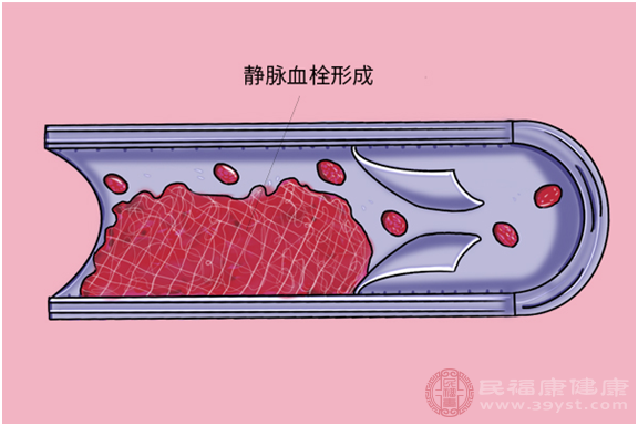 下肢靜脈血栓有什麼症狀