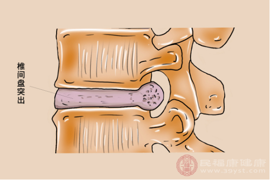 腰不疼一側屁股和腿疼是什麼原因