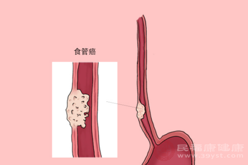 食管炎的症狀有哪些