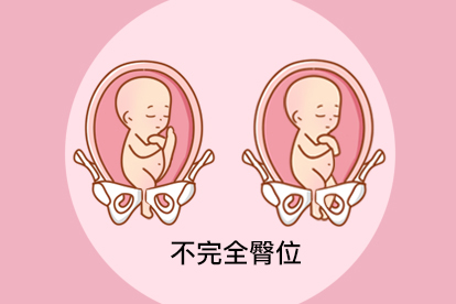 胎儿臀位是什么姿势图